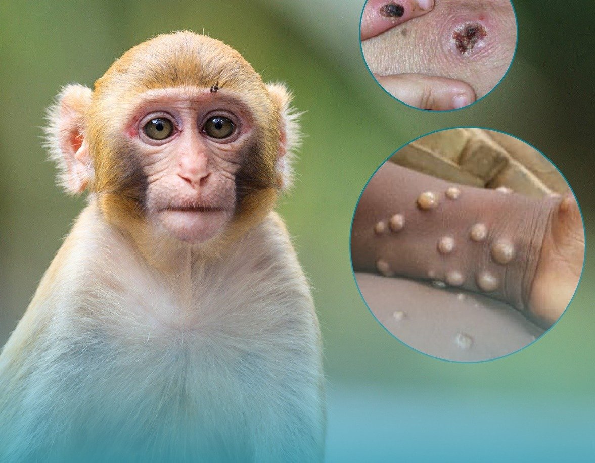 Bộ Y tế hướng dẫn chẩn đoán, quy trình điều trị bệnh đậu mùa khỉ từ Bộ Y tế (Ảnh: Internet)