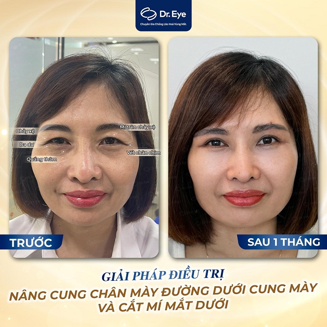 4 Tiêu chí lựa chọn địa chỉ nâng cung chân mày uy tín - Ảnh 1