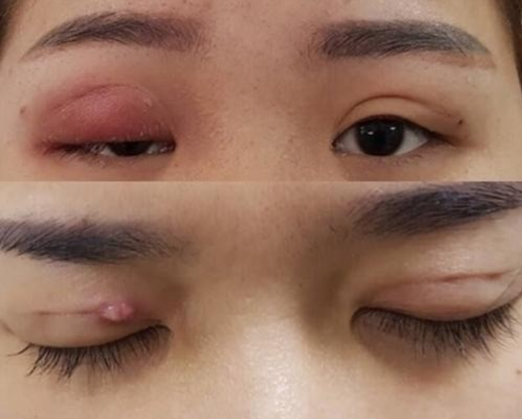 Cảnh Báo Hệ Lụy Về Chọn Nhầm Địa Chỉ Thẩm Mỹ Mắt Không An Toàn - Ảnh 2