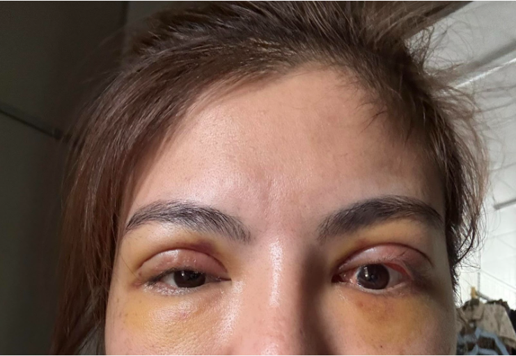 Cảnh Báo Hệ Lụy Về Chọn Nhầm Địa Chỉ Thẩm Mỹ Mắt Không An Toàn - Ảnh 3